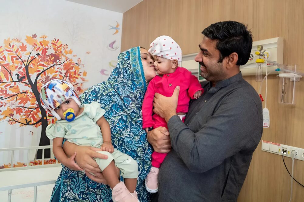 A historic operation separated craniopagus conjoined twins, thanks to 3D technology, offering a promising future