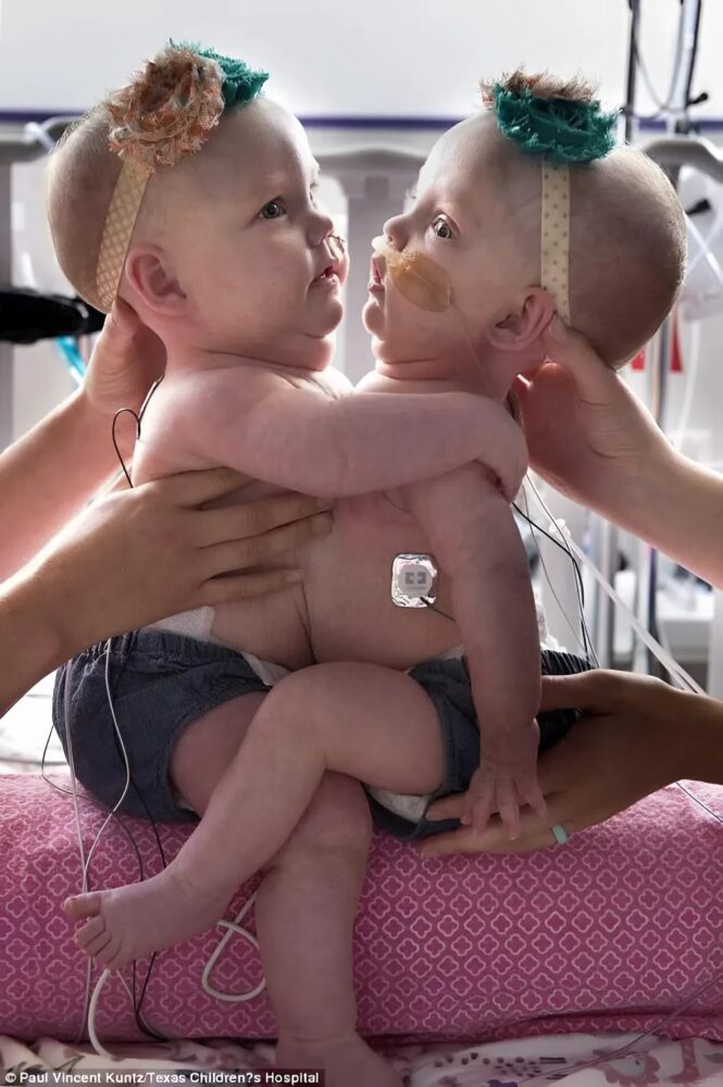 The miracle of separation: the moving story of anna and hope richards, a fight for life
