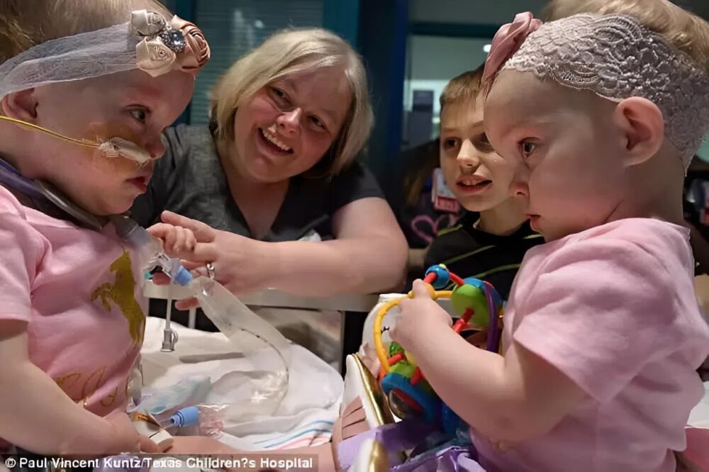 The miracle of separation: the moving story of anna and hope richards, a fight for life
