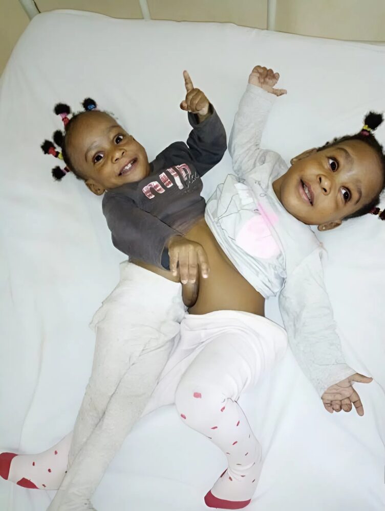 From fear to hope: the incredible journey of siamese twins bissie and eyenga, a fight for life
