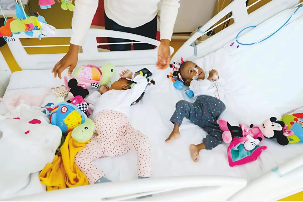 From fear to hope: the incredible journey of siamese twins bissie and eyenga, a fight for life